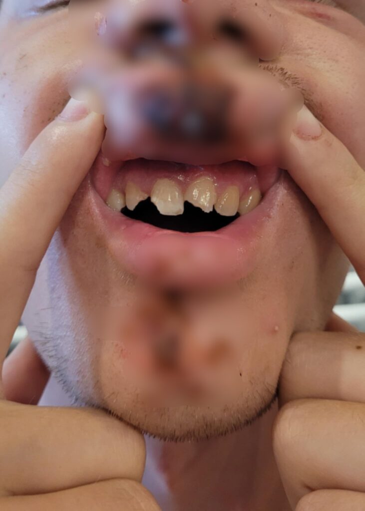 Mężczyzna z uśmiechem pokazuje zęby, trzymając palce na dolnej wardze w jasnym otoczeniu.