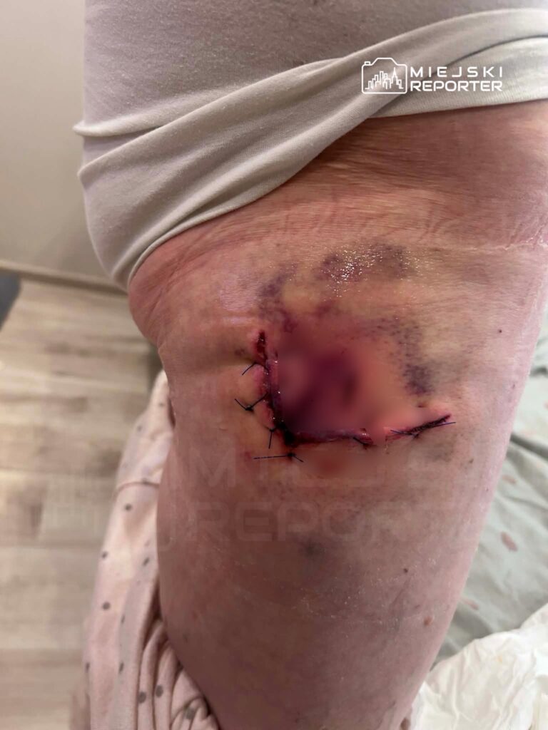 Na udzie osoby widoczna jest rana pooperacyjna z szwami oraz siniakiem w otoczeniu jasnej tkaniny.