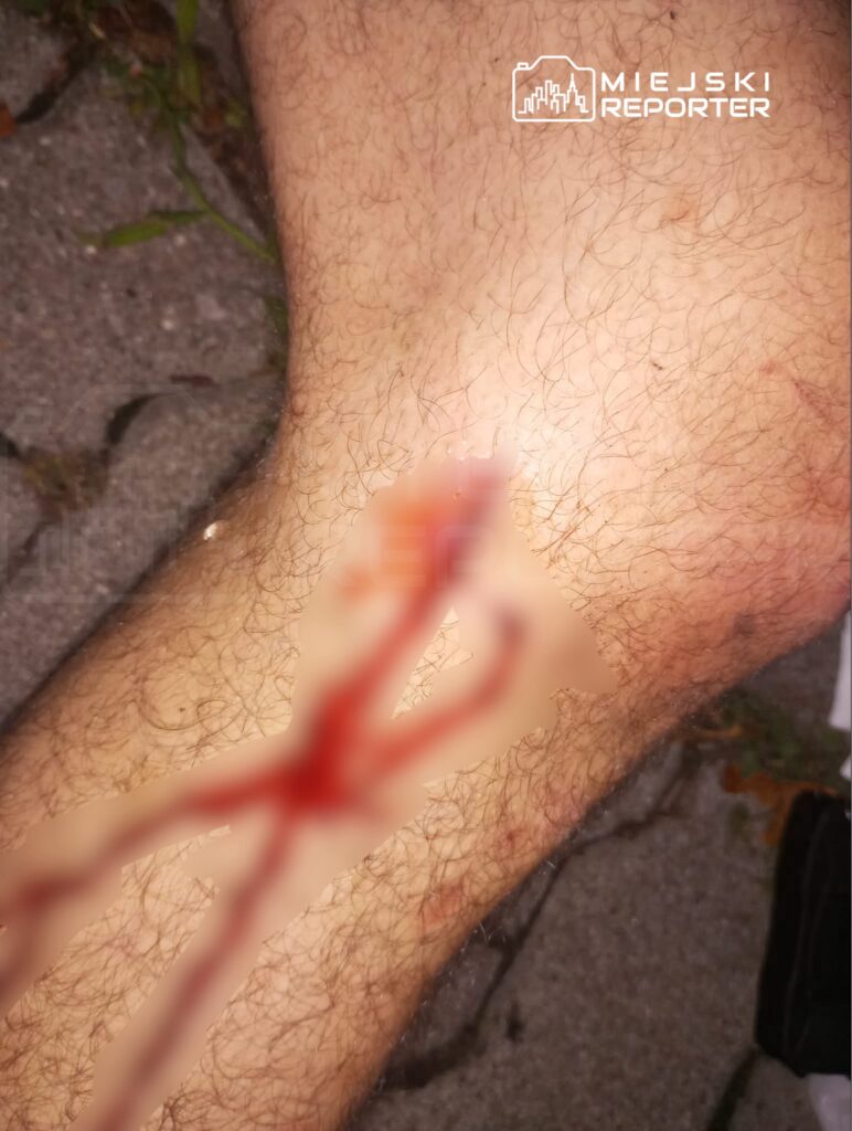 Rana na nodze mężczyzny z widoczną krwią, leżącego na ziemi w miejskim otoczeniu.