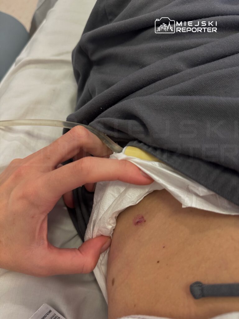 Osoba trzymająca dłoń na bandażu przy brzuchu, z widoczną raną oraz rurką medyczną w otoczeniu szpitalnym.