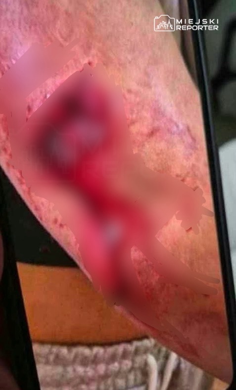 Zbliżenie na zaczerwienioną skórę z rozległym, ciemnoczerwonym śladem i widocznymi przebarwieniami.